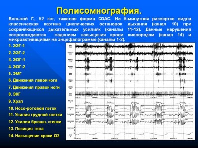 polisomnografiya-pokazaniya-priborov