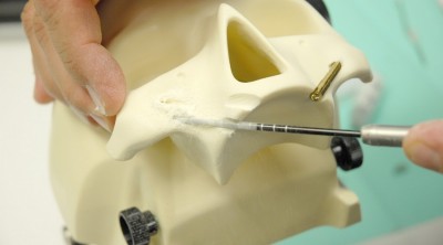 Скуловая имплантация зубов с использованием имплантов NOBEL