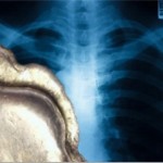 Рентгеновский снимок и диагноз